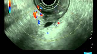 Papillary and Follicular Thyroid Cancer When and How To Treat or Watch and Wait Dr Busaidy [upl. by Bourgeois]