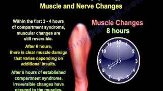 Compartment Syndrome Causes amp Pathophysiology  Everything You Need To Know  Dr Nabil Ebraheim [upl. by Nani]