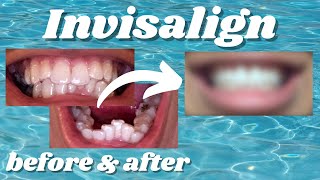 My Incredible Invisalign Transformation [upl. by Ltney]